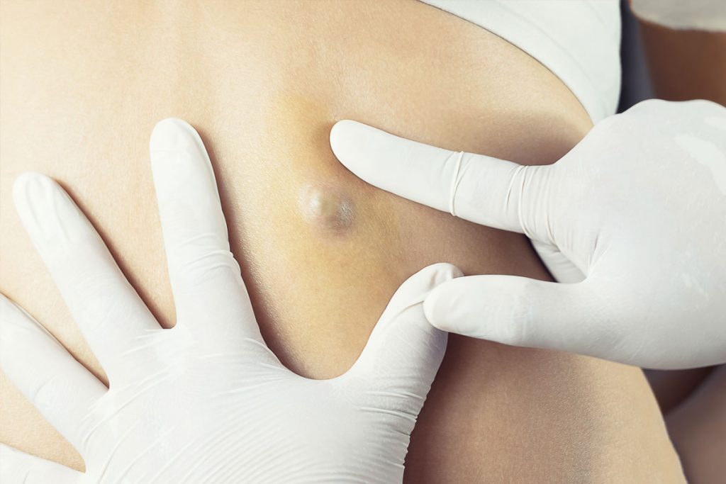 Sebaceous Cyst Removal